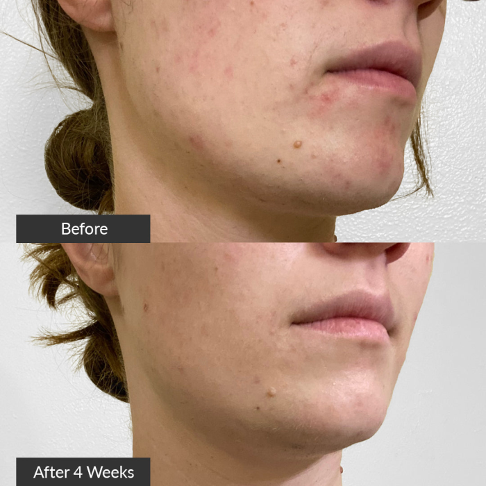 Videz obraza pred in po tretmaju z aparatom PMD Acne Clean